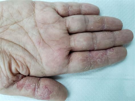 dermatite na mão